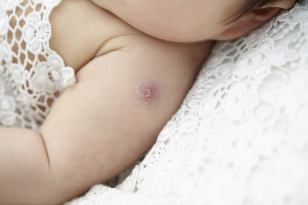 Bebê com uma cicatriz avermelhada no braço devido a vacina BCG