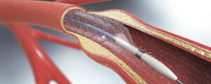 Imagem gráfica de stent inserido dentro de artéria em cateterismo
