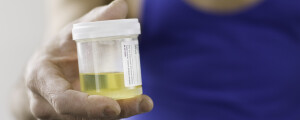 Close na mão de um individuo segurando um frasco com amostra de urina