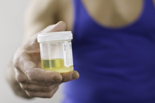 Close na mão de um individuo segurando um frasco com amostra de urina