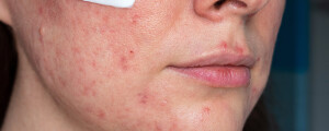 imagem aproximada do rosto de uma pessoa com melasma, contendo um pouco de ácido tranexâmico na bochecha