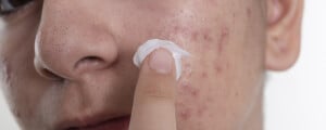 imagem aproximada do rosto de um homem aplicando pomada na acne