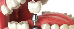 Implantes dentários ajudam a recuperar sorriso