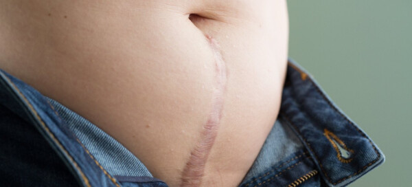Mulher com corte na barriga após Histerectomia
