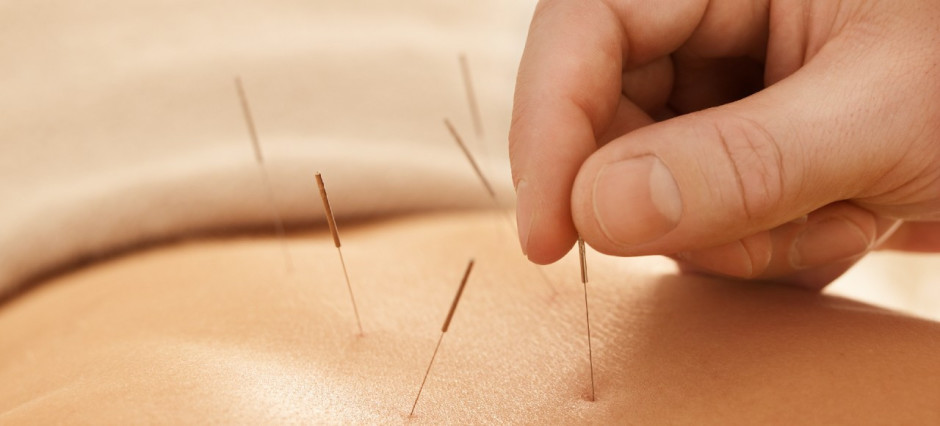 pele com agulhas de acupuntura